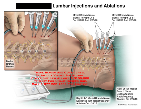 Limbus Injected Lumbar Injections and Ablations